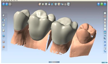 DentCAD設(shè)計的假牙模型